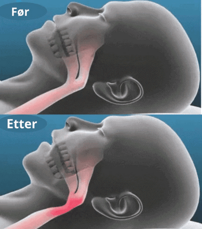 SnoreShield™ – Effektiv Anti-snarkningsenhet KVALIO