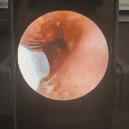 Slivor VisioEar: Läkargodkänd teknik för öronhälsa